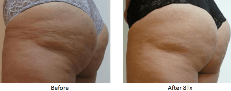 Cellulite Reduction