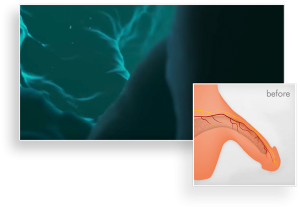 acoustic wave therapy tampa | Tampa Erectile Dysfunction