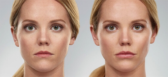 Before and after Juvederm filler