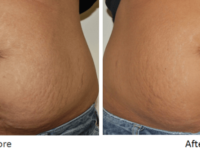 Body Contouring Before and After Images