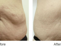 Skin Tightening Before and After Images