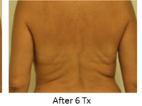 Body Contouring Before and After Images