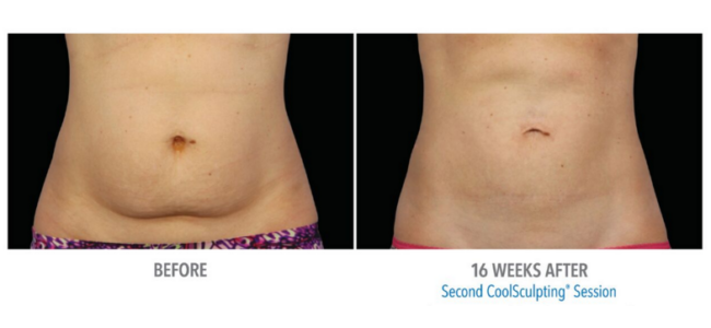 tampa coolsculpting