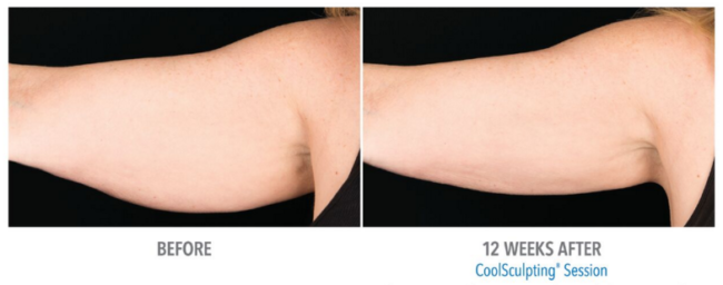 coolsculpting tampa