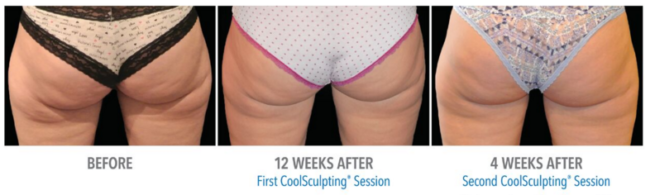 body sculpting tampa Session before and after behind