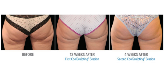 body sculpting tampa Session before and after behind