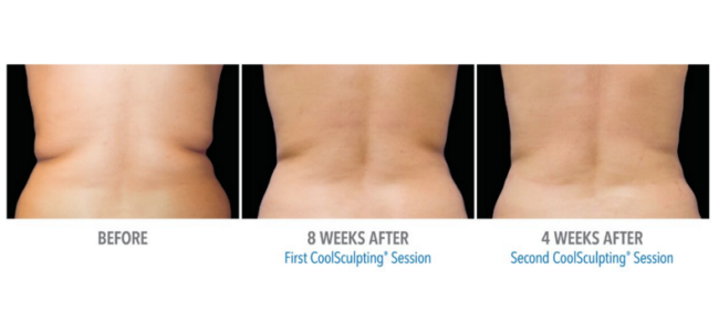 coolsculpting florida
