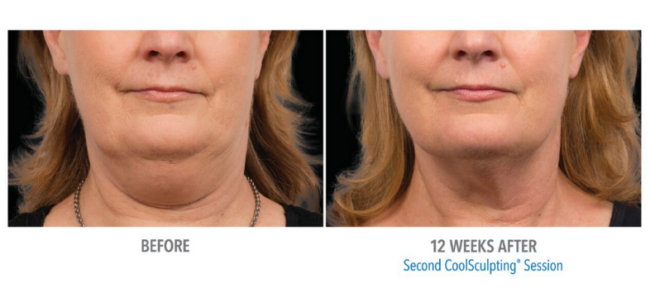Cool Sculpting Session Neck 12 weeks