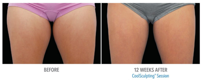 tampa coolsculpting