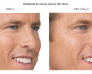 Before & After Botox Injections - Tampa Rejuvenation