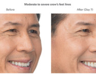 Clint botox before and after side view