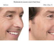 Jim botox before and after side view